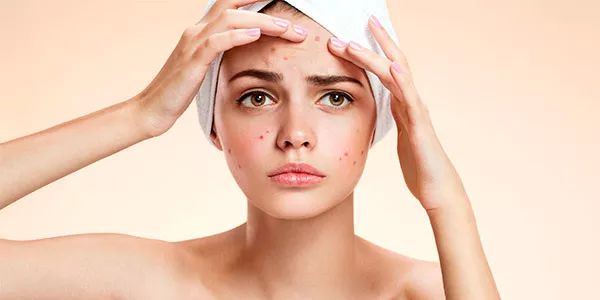 acne brufoli sebo